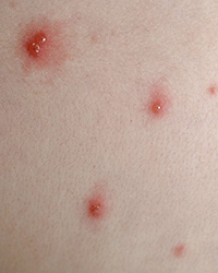 Close up photo of chickenpox blisters