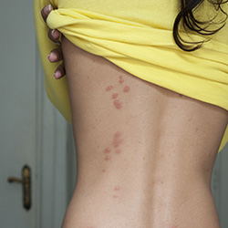 Photo of bed bug bites on a woman's back