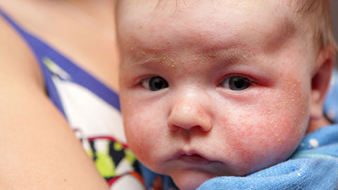 Photo of baby with eczema