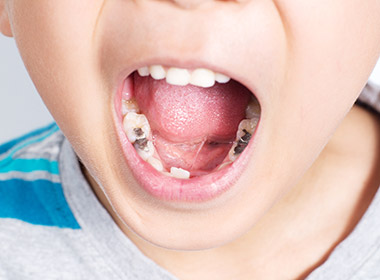 Young boy with mouth wide opened showing several tooth filling