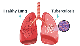 Illustration of a healthy lung compared to a TB lung