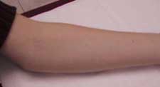 image of arm
